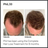 Minoxidil 5% Cutaneous Solution and Dermaroller - Hair Regrowth & Thickening - For Hair Loss & Thinning in Men - Stimulates Collagen and Reactivates Shrunken Follicles - Roller and 1 Month Supply