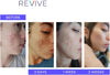 ® ClearSkin Revive LED Mask - For Blemish Prone Skin | Red & Blue Light beauty therapy for Face