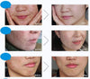 4in1 Face Acne Treatment Scar Removal Spots Whitening Oil Cream Face Masks Scar Blemish Marks Moisturizing Oil 100g+30g+30ml+4pcs X30g